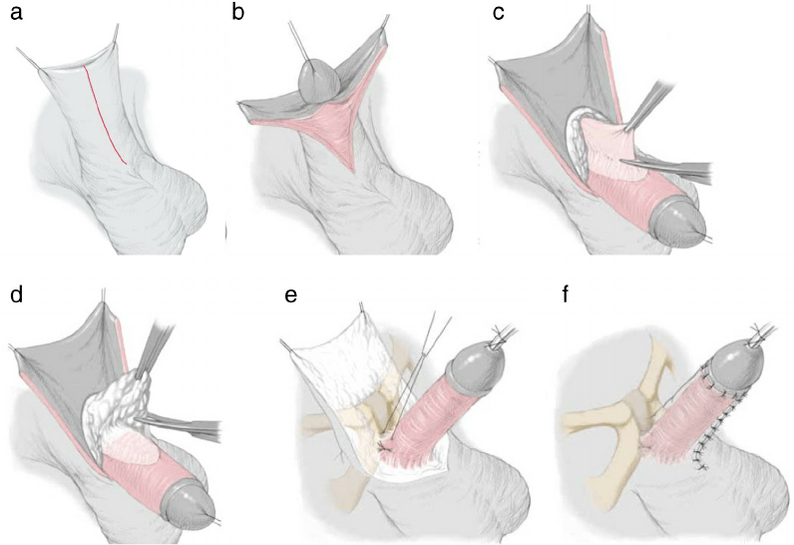 ligamentotomy առնանդամի մեծացման համար